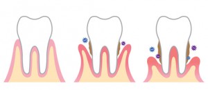 歯周病進行イメージ