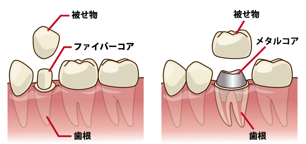 クラウン　ブリッジ　被せ物　技工　歯科